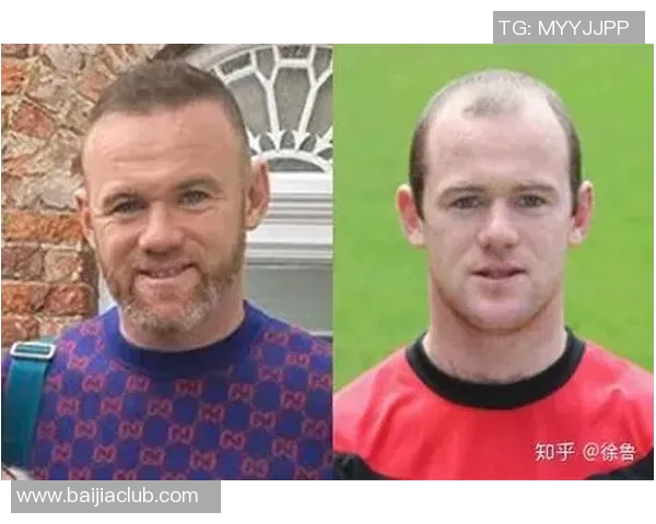 足球明星们的植发故事揭秘你不知道的那些球员经历